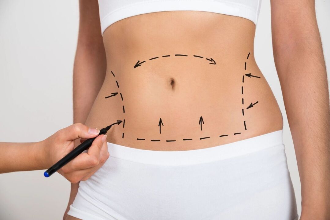 Abdominal marking before liposuction, figure correction